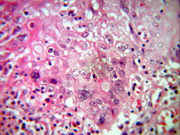 Swallowed food and liquids normally pass through it. Pathology Outlines Herpes Simplex Esophagitis