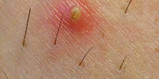 Because ingrown hair form by the hair growing back into the skin, they tend to affect skin areas with short, coarse, curly hair such as the pubic area. How To Treat Prevent Ingrown Hairs Dr Pimple Popper