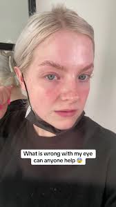 Any tips to help my eye would be deeply appreciated 🥲 #medicaladvice  #soreeye #medicalhumor