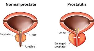 Image result for Prostatitis