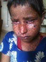 Xeroderma pigmentosum (xp) is a rare, autosomal recessive disease that is characterized by the extreme sensitivity of the skin to sunlight. Xeroderma Pigmentosum Simple English Wikipedia The Free Encyclopedia