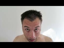 OH NO! Receding Hairline and Thinning Hair? Can't Have Short Haircut  Anymore!