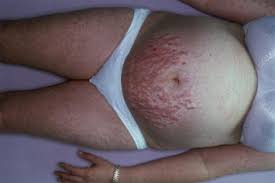 Image result for pruritic urticarial papules and plaques of pregnancy