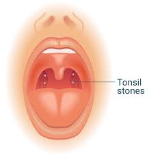 Image result for Tonsillolith