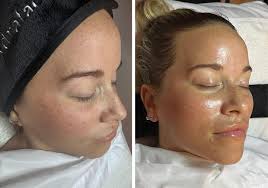 Hi, does anyone know where I can get a chemical peel in the Greenville area?