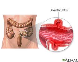 Women generally have a pelvic examination as well to rule out pelvic disease. Diverticulitis Information Mount Sinai New York