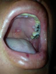 Image result for Oral herpes roof of mouth