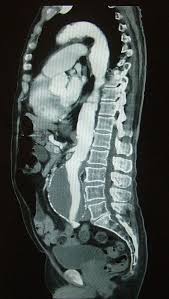 93 lake avenue danbury, ct 06810 p: Abdominal Aortic Aneurysm Clinical Features Teachmesurgery