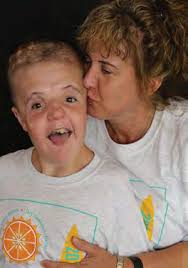 thankful for crouzon syndrome