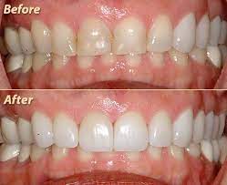 This Patient Had Severe Yellowing Of Her Teeth And Degradation Of Enamel Veneers Have Given Her A Beautif Dental Implants Dental Treatment Aesthetic Dentistry