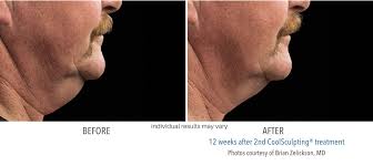 We did not find results for: Coolsculpting Before After Images Real Patient Results