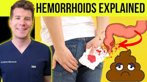 Image result for hemorrhoids