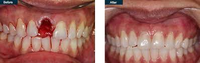 Check spelling or type a new query. Before After Nyc Dental Implants Manhattan Ny