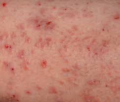 Image result for skin rash similar to scabies