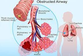 How do you get asthma? 12 Asthma Signs Types Causes Tests Prevention