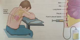 Image result for Thoracentesis