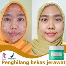 Penghilang Fordyce Spot