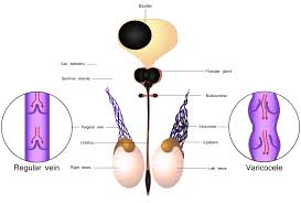 Image result for Varicocele