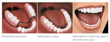 Partial dentures are a great option for some patients who have missing teeth. Same Day Dentures Wilbraham Ma Partial Dentures Springfield Ludlow Crowns Bridges Hampden East Longmeadow Chicopee Vanguard Dental