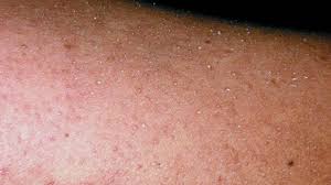 Tiny red spots on the upper legs, or any location, can sometimes red dots on legs, mddk online medical doctor; Little Red Dots On Skin Naturalskins