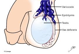 Image result for Varicocele