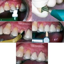 We did not find results for: 23 Cements Pocket Dentistry