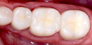 Do teeth fillings hurt metal. Types Of Dental Fillings Eagle Harbor Dentist