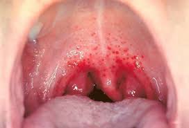 It may be due to the bleeding disorders or excess pressure found on the blood capillaries. Red Spots On Roof Of Mouth Itchy Sores Bumps Dots With Sore Throat Brighter Press