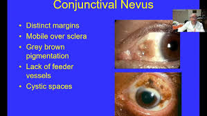 Image result for melanosis sclera