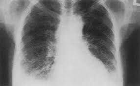 مياه على الرئة اعراضها واسبابها والوقاية منها موسوعة