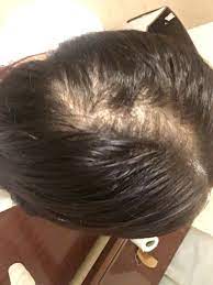 It can be very bothersome if it comes together with itchy scalp. My Hair Is Thinning With Very Shiny Scalp And Vellus Hair All Over My Scalp That Seems To Be Almost Colorless Photos