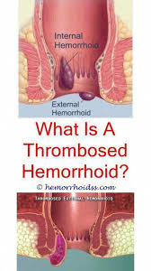 There Are Many Natural Home Remedy That Will Certainly Help Reduce Excruciating Piles The Last Option For E In 2020 Hemorrhoids Hemorrhoids Treatment Get Rid Of Warts