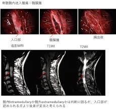 Look up in linguee suggest as a translation of 脊髄 è„³ç¥žçµŒå¤–ç§'ã®ç—…æ°— é«„è†œç¨® ç—…æ°—ã®æ²»ç™‚ å¾³æ´²ä¼šã‚°ãƒ«ãƒ¼ãƒ—