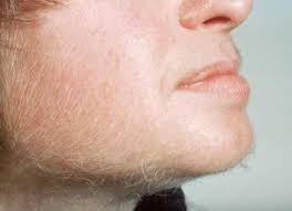 This woman should check with her doctor if she is on medications and is uncertain whether they can cause hair growth. Excessive Sugar Consumption Causes Facial Hair In Women