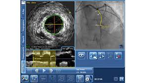 Not everyone has the chance to see this living being with their own eyes. Eagle Eye Platinum St Digital Ivus Short Tip Catheter Philips Healthcare