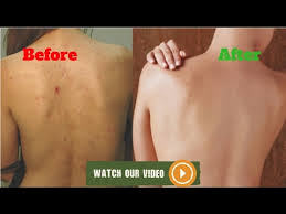 Look for ingredients (like salicylic acid) that break up blocked, clogged pores and decrease back acne inflammation. Howto How To Get Rid Of Acne Scars On Back