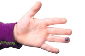 How do we treat a blood blister on lip that won't go away? Blood Blisters Causes Diagnosis And Treatment