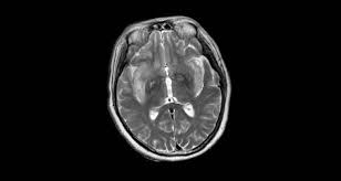 Image result for HSV Encephalitis