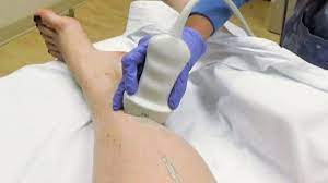 Compression Stockings Ineffective In Treating Deep Vein Thrombosis Study Ctv News