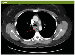 Patients present with nonvariceal upper gi bleeding. Boerhaave Syndrome In A 41 Year Old Female Journal Of Urgent Care Medicine