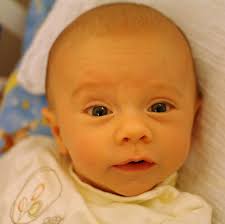 Jaundice in New Borns