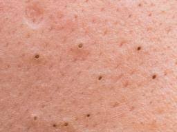 The first of firsts for getting rid of blackheads is moisturising the skin with the right cream or moisturiser. How To Get Rid Of Blackheads 7 Natural Remedies And What Not To Do