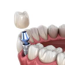 If they are taken care of properly and not misused, they can even last longer than 15 years. Dental Implants Aiken Sc Implant Dentistry Center For Dentistry