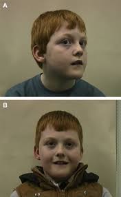 Nystagmus in Childhood