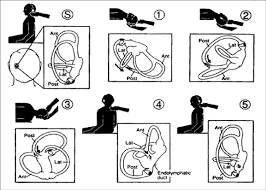 Image result for Canalith Repositioning Procedure