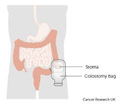 Types Of Surgery Ovarian Cancer Cancer Research Uk