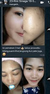 Maybe you would like to learn more about one of these? Review Cream Hn Platinum Bpom Original Manfaat Harga Efek Samping Perbedaan Asli Dan Palsu