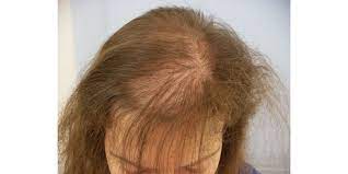 Scegliete con cura i prodotti che usate per lavare i vostri capelli, prediligendo shampoo privi di tensioattivi e a base di oli o latti, che . Post Parto E Perdita Capelli