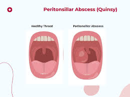 Image result for Peritonsillar Abscess