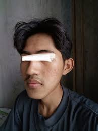 Kemerahan dan bruntusan